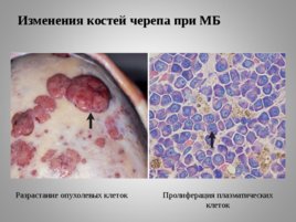 Опухоли кроветворной и лимфоидной тканей Часть II, слайд 36