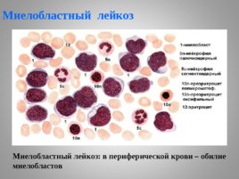 Опухоли кроветворной и лимфоидной тканей Часть II, слайд 4