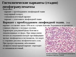 Опухоли кроветворной и лимфоидной тканей Часть II, слайд 50