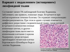 Опухоли кроветворной и лимфоидной тканей Часть II, слайд 53