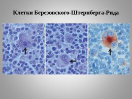 Опухоли кроветворной и лимфоидной тканей Часть II, слайд 54