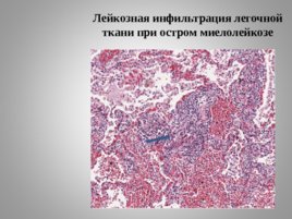Опухоли кроветворной и лимфоидной тканей Часть II, слайд 7