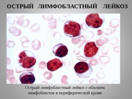 Опухоли кроветворной и лимфоидной тканей Часть II, слайд 8