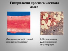 Опухоли кроветворной и лимфоидной тканей Часть II, слайд 9