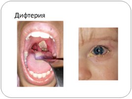 Вакцинация-залог здорового будущего, слайд 14