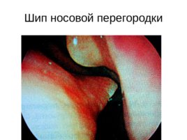 Анатомия, физиология носа, слайд 28