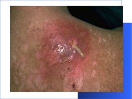 Гнойно-восполительные заболевания кожи и подкожной клетчатки у детей, слайд 10