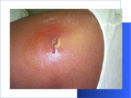 Гнойно-восполительные заболевания кожи и подкожной клетчатки у детей, слайд 12