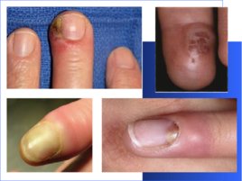 Гнойно-восполительные заболевания кожи и подкожной клетчатки у детей, слайд 17