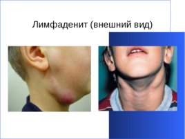 Гнойно-восполительные заболевания кожи и подкожной клетчатки у детей, слайд 23