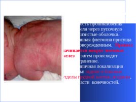 Гнойно-восполительные заболевания кожи и подкожной клетчатки у детей, слайд 25
