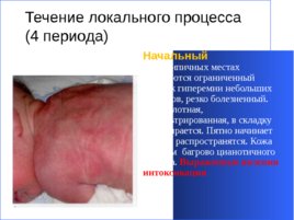Гнойно-восполительные заболевания кожи и подкожной клетчатки у детей, слайд 28