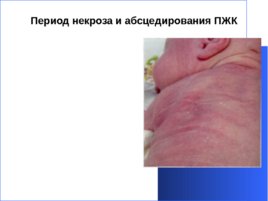 Гнойно-восполительные заболевания кожи и подкожной клетчатки у детей, слайд 29