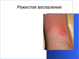 Гнойно-восполительные заболевания кожи и подкожной клетчатки у детей, слайд 35