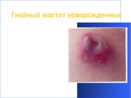 Гнойно-восполительные заболевания кожи и подкожной клетчатки у детей, слайд 39
