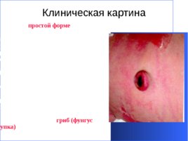 Гнойно-восполительные заболевания кожи и подкожной клетчатки у детей, слайд 44