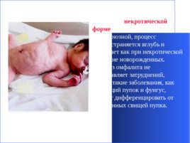 Гнойно-восполительные заболевания кожи и подкожной клетчатки у детей, слайд 46