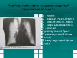 Методы рентгенодиагностики, слайд 40