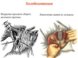 Топографическая анатомия и оперативная хирургия общего желчного протока, слайд 13