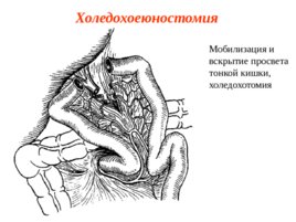 Топографическая анатомия и оперативная хирургия общего желчного протока, слайд 17