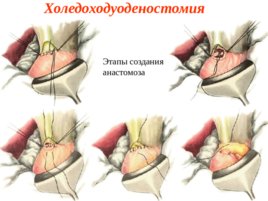 Топографическая анатомия и оперативная хирургия общего желчного протока, слайд 21