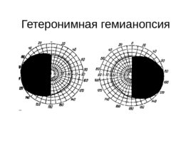 Зрительные функции, рефракция и аккомодация глаза, слайд 32