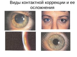 Зрительные функции, рефракция и аккомодация глаза, слайд 81