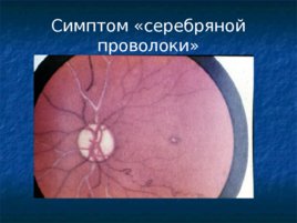 Глазные проявления общих заболеваний, слайд 11