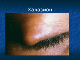 Глазные проявления общих заболеваний, слайд 22