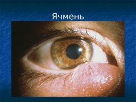 Глазные проявления общих заболеваний, слайд 24