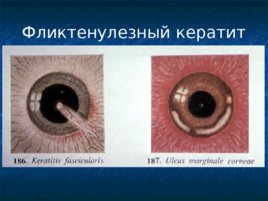 Глазные проявления общих заболеваний, слайд 58