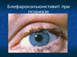 Глазные проявления общих заболеваний, слайд 68