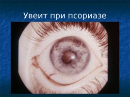 Глазные проявления общих заболеваний, слайд 70