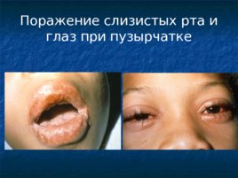 Глазные проявления общих заболеваний, слайд 75