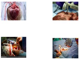 Топографическая анатомия и оперативная хирургия сердца, слайд 14