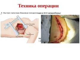 Топографическая анатомия и оперативная хирургия сердца, слайд 29