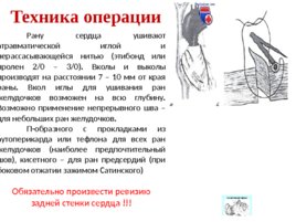 Топографическая анатомия и оперативная хирургия сердца, слайд 32