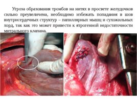Топографическая анатомия и оперативная хирургия сердца, слайд 34