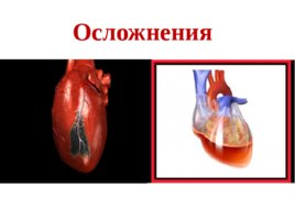 Топографическая анатомия и оперативная хирургия сердца, слайд 37