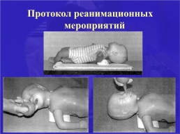Асфиксия новорожденного. Родовая травма., слайд 23