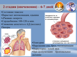 Проведение сестринского процесса при пневмонии, слайд 36