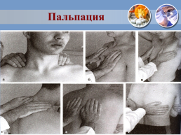 Проведение сестринского процесса при пневмонии, слайд 58