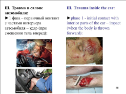 Травматология (частные вопросы), слайд 17