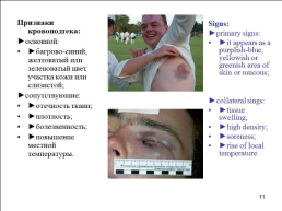 Травматология (общие вопросы), слайд 12