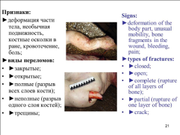 Травматология (общие вопросы), слайд 22
