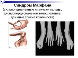 Хромосомные болезни, слайд 14