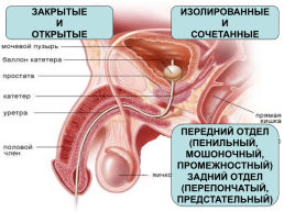 Повреждения мочеполовых органов, слайд 41
