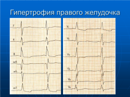 Электрокардиография. Лекция для студентов 3 курса, слайд 32