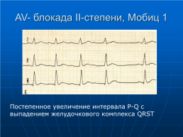 Электрокардиография. Лекция для студентов 3 курса, слайд 37