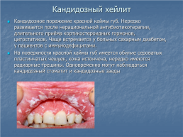 Хейлит – это воспалительное или дистрофическое заболевание губ с преимущественным поражением красной каймы губ, слайд 13